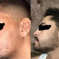 ریش مال مرده