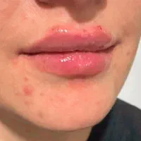 ژل لب ۶۵۰بوتاکس آنزیم لب زاویه فک گونه کانتورینگ|خدمات آرایشگری و زیبایی|شیراز, منطقه هوایی شهید دوران|دیوار