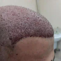 کاشت مو طبیعی له روش میکروfit وsut|خدمات آرایشگری و زیبایی|رامشیر, |دیوار