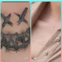 ریموو تتو با لیزر کیوسوییچ|خدمات آرایشگری و زیبایی|خرم‌آباد, |دیوار