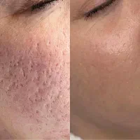 من اسکار،ولک پوستتو درمان میکنم بدون سوزن ودرد|خدمات آرایشگری و زیبایی|کاشان, دشت چال|دیوار