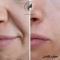 جشنواره ویژه تزریق ژل و مزو و پی آرپی درمطب