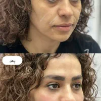 ژل اودری اصل سی سی 350بوتاکس ۵۰۰و خال برداری|خدمات آرایشگری و زیبایی|قم, زنبیل آباد|دیوار