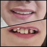 کامپوزیت دندان از دم قسط