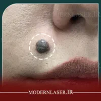 درمان کامل انواع خال و زائده های پوستی بدون بازگشت|خدمات آرایشگری و زیبایی|اصفهان, سعادت‌آباد|دیوار