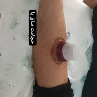 حجامت.زالو.نیدل لاغری.بواسیر.یون تراپی یا سم زدایی|خدمات آرایشگری و زیبایی|مشهد, توس (بلوار توس)|دیوار