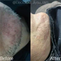 الکترولیز برای همیشه از شر موهای سفید خلاص شوید