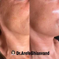 جوانسازی و لیفت حرفه‌ای پوست