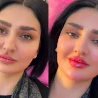 ژل و بوتاکس