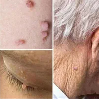 کلینیک لیزر کرایو زگیل خال میخچه حجامت زالو بوتاکس|خدمات آرایشگری و زیبایی|شیراز, حافظیه|دیوار