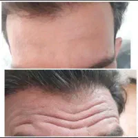 خدمات ژل بوتاکس،مزوتراپی،پی ارپی،کاشت مووابرو