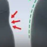 تخفیف ویژه فیلربادی تخصصی باسن،بیکینی،پشت دستcc198
