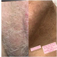 لیزر، ژل،بوتاکس،خال برداری و الکترولیز،لیبیاپلاستی|خدمات آرایشگری و زیبایی|شیراز, پانصد دستگاه ارتش|دیوار
