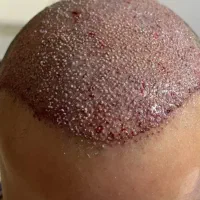 کلینیک تخصصی کاشت مو و ابرو
