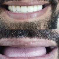 دندان مصنوعی اقساطی، پروتز، BPS، لردگان