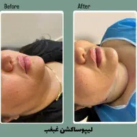 تزریق صورت  و تخلیه غبغب