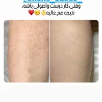 لیزر موهای زائد الکس دکا ۲۰۲۴ بدون تماس با بدن|خدمات آرایشگری و زیبایی|سبزوار, ولیعصر (نجار آباد)|دیوار