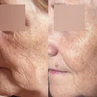 تزریق جوانسازها و ژل لب و گونه|خدمات آرایشگری و زیبایی|ورامین, ورامین|دیوار