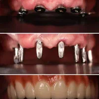 شرایط ویژه جشنواره دندانپزشکی ایمپلنت اوردنچر روکش|خدمات آرایشگری و زیبایی|تبریز, |دیوار