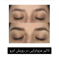 آف مزوتراپی و مزونیدلینگ|خدمات آرایشگری و زیبایی|اهواز, گلستان|دیوار