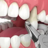 دندان پزشکی اسما /کشیدن تخصصی دندان/در چند ثانیه