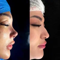 جراحی بینی با بیهوشی 30