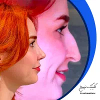 عمل زیبایی بینی قبل عید با نصف قیمت