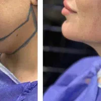 تخفیف ویژه تزریق چربی و ژل و بوتاکس