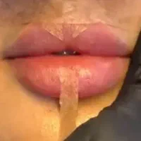 تخفیفات نوروزی  ژل بوتاکس مزو میکرو