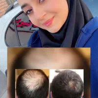 ریشاتو پرپشت کن توی یه بازه زمانی کوتاه بدون عوارض