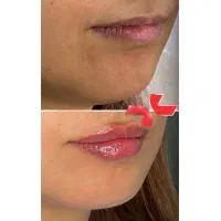 فیلر لب ،شقیقه، چانه،زاویهفک طبیعی با تکنیکتخصصی|خدمات زیبایی و سلامت|شیراز, معالیآباد|دیوار