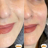 جشنواره تزریق ژل و بوتاکس (توسط پزشک)|خدمات آرایشگری و زیبایی|اصفهان, عباسآباد|دیوار