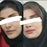 رفع چین وچروک های بدن