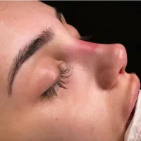عمل/بینی/ جراحی زیبایی/بدون تامپون/اقساطی|خدمات آرایشگری و زیبایی|کرج, عظیمیه|دیوار