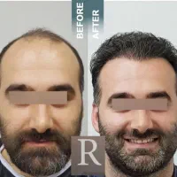 عمل بینی بلفارو پلاستی ساکشن غبغب ابدو ساکشن|خدمات آرایشگری و زیبایی|مشهد, ملک‌آباد|دیوار