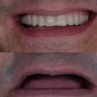 دندان مصنوعی متحرک|خدمات زیبایی و سلامت|تهران, قیطریه|دیوار