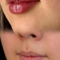 تزریق وآموزش فیلر و بوتاکس|خدمات آموزشی|فردیس, فردیس|دیوار
