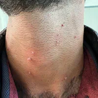 درمان انواع زگیل وتبخال تناسلی فقط در ۱جلسه