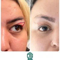 جراحی پلک باشرایط اقساطی درتبریز