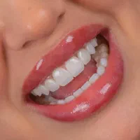 کامپوزیت لمینت روکش|خدمات زیبایی و سلامت|کرج, گوهردشت|دیوار