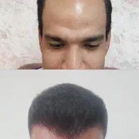 کاشت مو فقط 8700|خدمات آرایشگری و زیبایی|شیراز, معالی‌آباد|دیوار