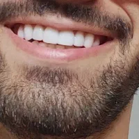 دندانپزشکی عصب کشی ترمیم کامپوزیت مناسب ترین قیمت|خدمات آرایشگری و زیبایی|مشهد, ده دی|دیوار