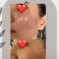 لیزر تتو وروشن کننده بدن|خدمات آرایشگری و زیبایی|پاکدشت, پاکدشت (مامازند)|دیوار