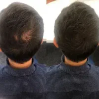 تراکم سازی ریشه ای|آرایشی، بهداشتی، درمانی|مشهد, سعد آباد|دیوار
