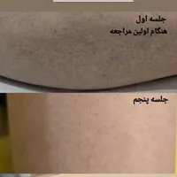 لیزر موهای زائد|خدمات آرایشگری و زیبایی|فولادشهر, B5|دیوار