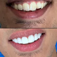 لابراتوار دندانسازی زیبایی کامپوزیت فکی۷میلیون