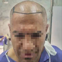 جشنواره کاشت مو|خدمات آرایشگری و زیبایی|شیراز, قصرالدشت|دیوار