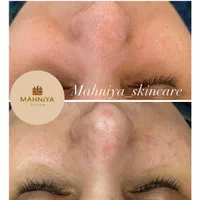 فیشال،آلگاپیل(پوست مار)هایفوتراپی،پوست کره ای|خدمات آرایشگری و زیبایی|قم, دورشهر|دیوار