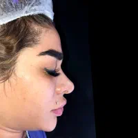 تیپ پلاستی ۱۶ بدون بیهوشی|خدمات آرایشگری و زیبایی|تهران, آسمان|دیوار