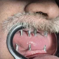 دندانپزشکی کامپوزیت ایمپلنت قسطی عیدانه